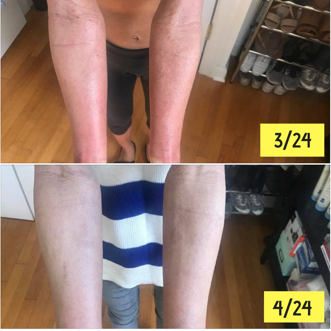 Personalized Eczema Coaching Program