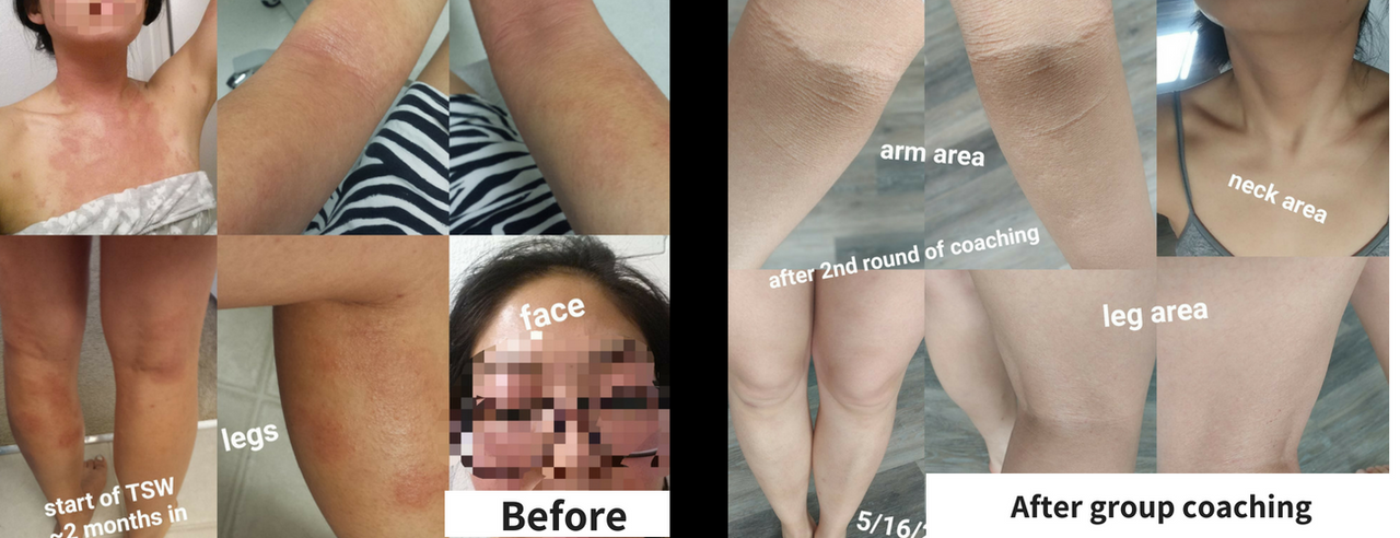 Personalized Eczema Coaching Program